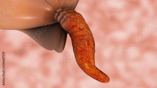 Obraz na plátně Close Up Assessment of Appendix Swelling