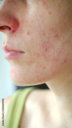 Close up young woman face with red allergic rash, displaying symptoms of atopic dermatitis, rosacea, or skin irritation caused sensitivity to food or cosmetics. Woman showing facial skin allergy rash