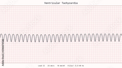 Ventricular Tachycardia VTach Rapid Heartbeat Arrhythmia Emergency ECG EKG Monitor 4K Video Code Blue Cardiology Clinic Vital Signs Patient Tracing Healthcare Critical Care Heart Disease Display
