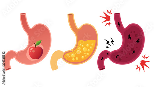 Fotografi The stomach digests food normally then becomes inflamed and painful with 403