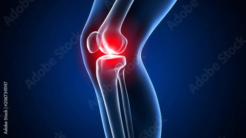 Medical Illustration of a Knee with Inflamed Joint Pain on Blue Background for Healthcare and Healthcare Marketing on Adobe Stock and Shutterstock