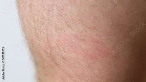 Allergic spots on the patients body after vaccination, side effects.