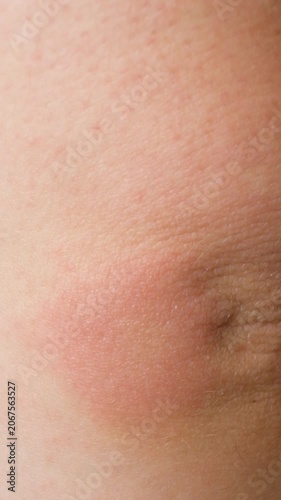 Close-up of a red allergic rash and skin irritation on a human skin