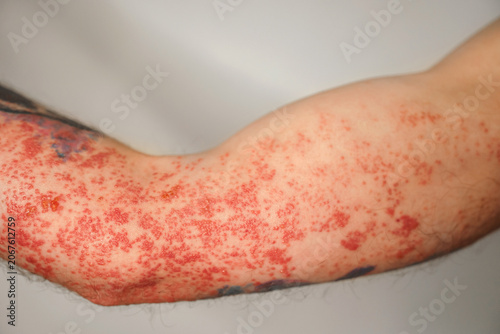 Vászonkép Close up of human arm showing severe skin rash with red bumps and irritation