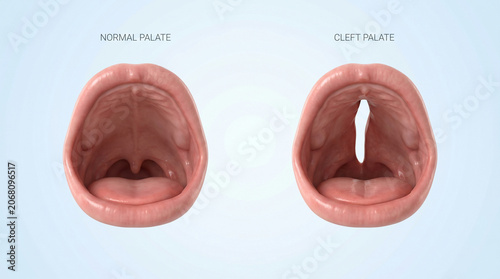 3D Medical Illustration of Normal Palate vs Cleft Palate Anatomy