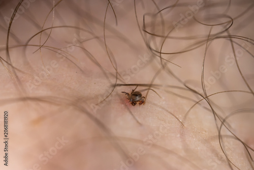 Tableau sur toile Extreme macro photograph showing a tick attached to human skin among body hair
