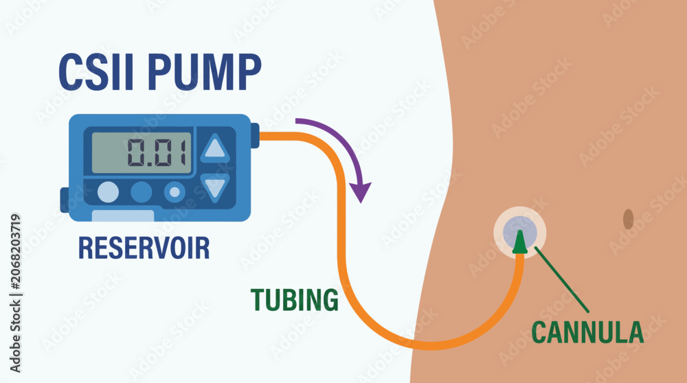 Fotografie Continuous Subcutaneous Insulin Infusion CSII Pump Mechanism