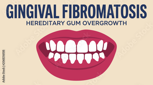 Fotografía Gingival Fibromatosis Hereditary Gum Overgrowth