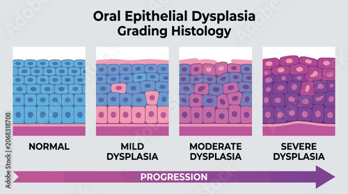 Bild auf Leinwand Oral Epithelial Dysplasia Grading Histology