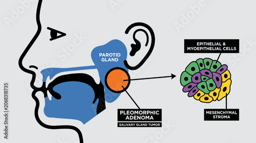 Fotografie Salivary Gland Tumor Pleomorphic Adenoma Diagram