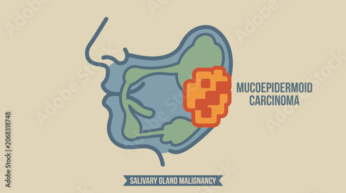 Photos Mucoepidermoid Carcinoma Salivary Gland Malignancy