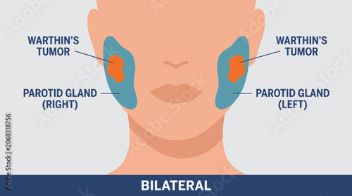 Tableau sur toile Warthin's Tumor Parotid Gland Bilateral