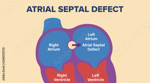 Принти на полотні Atrial Septal Defect Hole Between Upper Heart Chambers Illustration