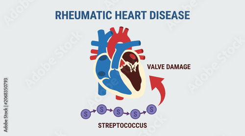 Tableau sur toile Rheumatic Heart Disease Streptococcal Valve Damage Illustration