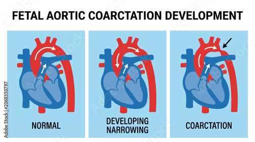 Tableau sur toile Coarctation of Aorta Narrowing Fetal Development Diagram