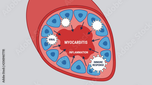 Фотография Myocarditis Viral Inflammation Heart Muscle Immune Response