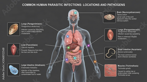 Medical Illustration: Schematic Map of Common Human Parasitic Infections and Their Organ Locations.