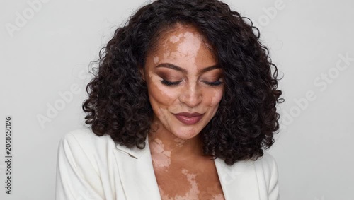 Real woman with vitiligo skin and dark curly hair in white blazer beauty portrait