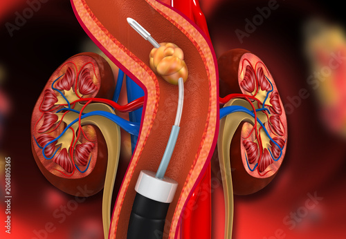 Detailed medical illustration of a human kidney cross-section showing anatomical structures and surgical stone removal.