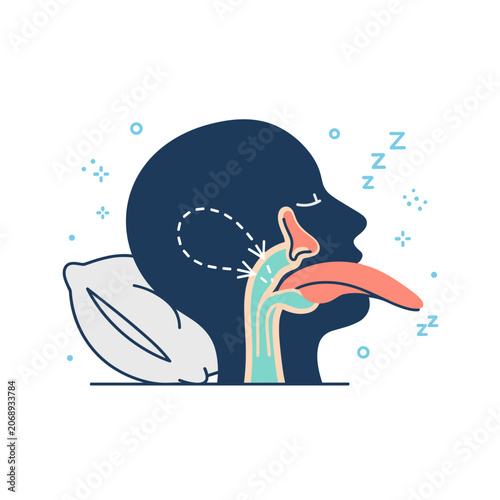 Obstructive Sleep Apnea Airway Diagram Vector Illustration