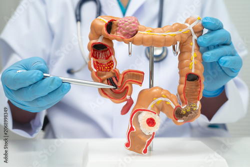 Obraz na plátně Colorectal cancer, doctor holding intestine colon human anatomy model