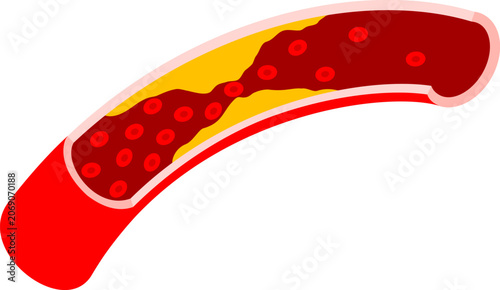 Artery Blockage with Red Blood cell. Atherosclerosis Artery Plaque Disease