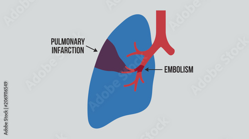 Quadro su tela Pulmonary Infarction Wedge-Shaped Necrosis from Embolism