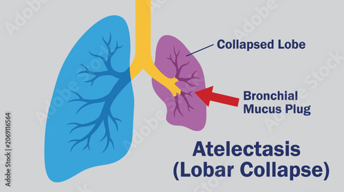 Bild auf Leinwand Atelectasis Lobar Collapse from Bronchial Mucus Plug Obstruction