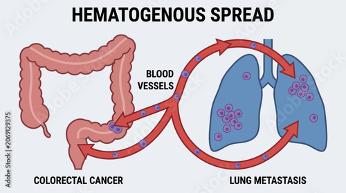 Photos Lung Metastasis Hematogenous Spread of Colorectal Cancer