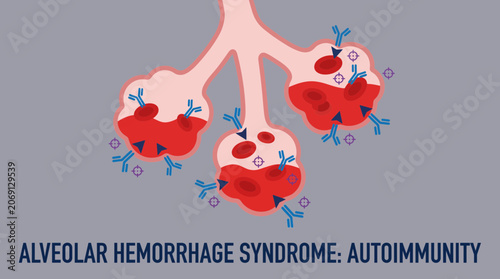 Принти на полотні Alveolar Hemorrhage Syndrome Blood Filling Air Space from Autoimmunity