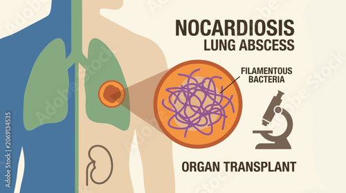 Cuadro en lienzo Nocardiosis Filamentous Bacterial Lung Abscess in Organ Transplant