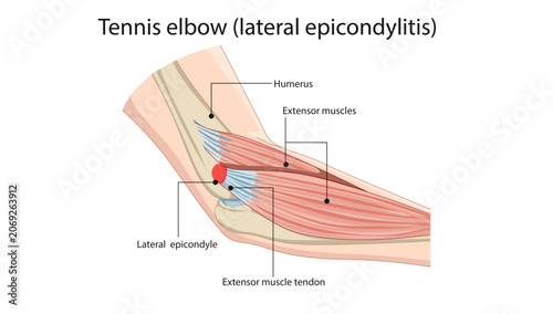 Obraz na płótnie Tennis Elbow (Lateral Epicondylitis) Anatomy, lateral epicondylitis (tennis elbow), showing inflammation and microtears of the common extensor tendon at the lateral epicondyle