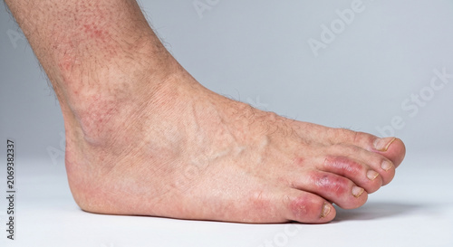 chilblains disease man's leg