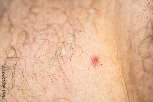 Billede på lærred Small red inflamed bump on human skin with body hair