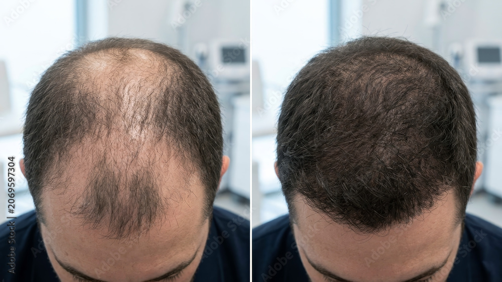 Obraz premium Hair restoration before and after results, male pattern baldness solution, effective hair regrowth treatment, non-surgical hair loss remedy, visible transformation, hair density improvement