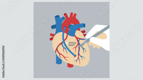 Quadro em tela Coronary Artery Bypass Graft Surgery Illustration CABG