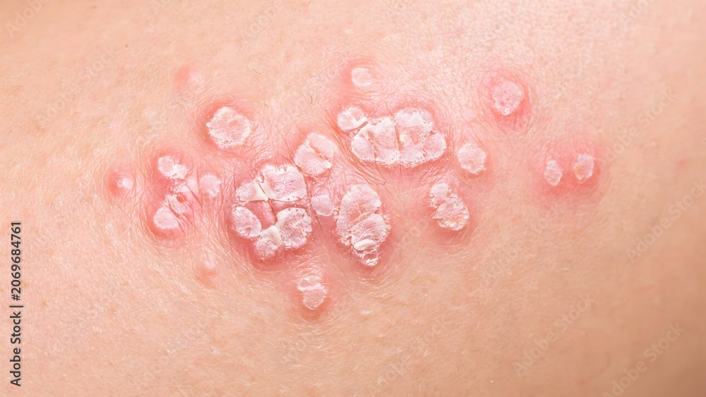 Fototapeta premium Skin rash, herpes zoster, shingles, viral infection, close-up