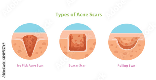 Fotografie Types of Acne Scars Illustration Ice Pick, Boxcar and Rolling Scars
