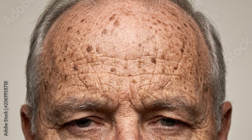 Macro view of elderly man forehead showing severe cutaneous photoaging with extensive sunspots and deep wrinkles