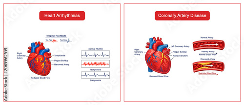 Heart Arrhythmias and Coronary Artery Disease diagram raster illustration. Medical science educational illustration