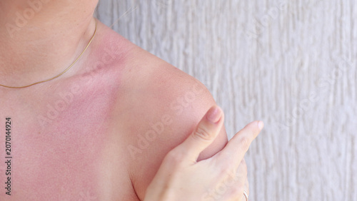 Fotografie Woman pointing to red sunburned shoulder and chest with visible tan lines, skincare problem after excessive sun exposure in summer