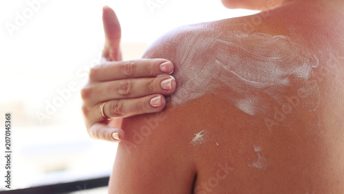фотографія Close-up of red sunburned shoulder and upper back with soothing after sun cream applied to irritated skin, summer skincare and sun protection concept