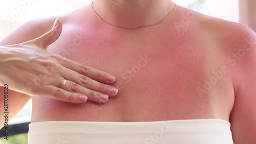 Obraz na plátně Woman applying soothing cream to red sunburned chest and shoulders after summer sun exposure, skincare and after sun care concept