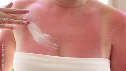 Foto Woman with painful sunburned skin on chest and shoulders after summer vacation, close-up of red irritated skin with tan lines, after sun care and UV protection concept
