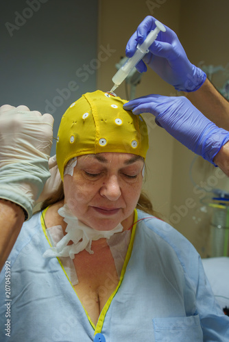 Patient receiving a sleep study, a polysomnography for neurological condition diagnosis, with technicians applying electrode gel