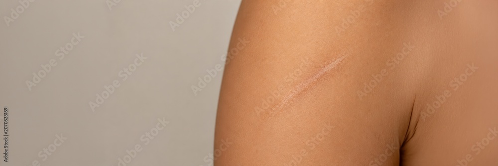 Fototapeta premium Healed scar on upper arm and shoulder in close up, skin recovery, dermatology, medical treatment, healthcare concept