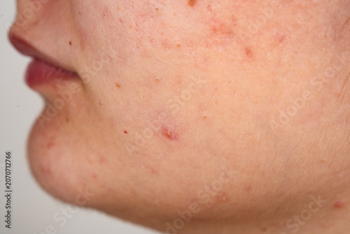 Fotografie Acne skin with inflamed pimples