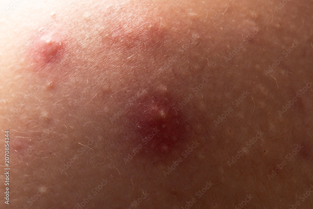 Fototapeta premium Skin problem background with infected bumps and acne. Inflamed skin bumps acne macro. Close up acne on skin. Irritated acne skin.