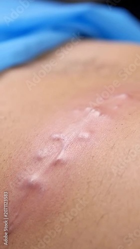 Realistic Close-Up Of Scar Tissue On Human Skin Showcasing Healing Process For Medical And Health Visuals