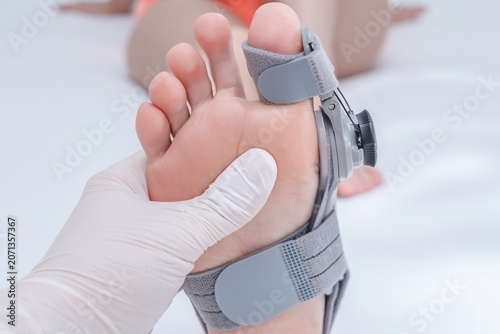 Close up view on orthopedist examines leg with hallux valgus deformity of big toe in orthopedic bandage